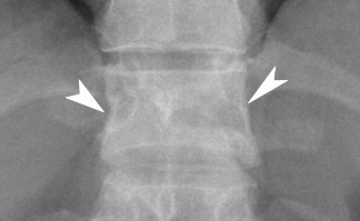 Chance Fracture (flexion-distraction injury) - Spine - Orthobullets